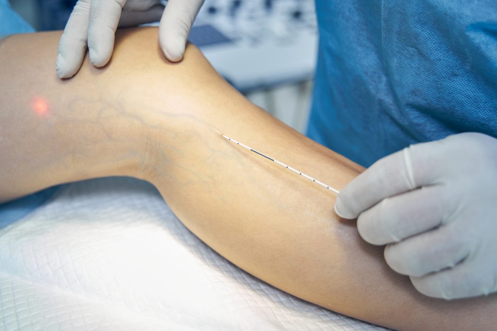 Sclerotherapy — CPCA